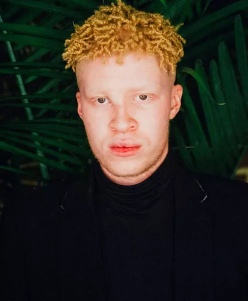 Albinism in pictures - #10 