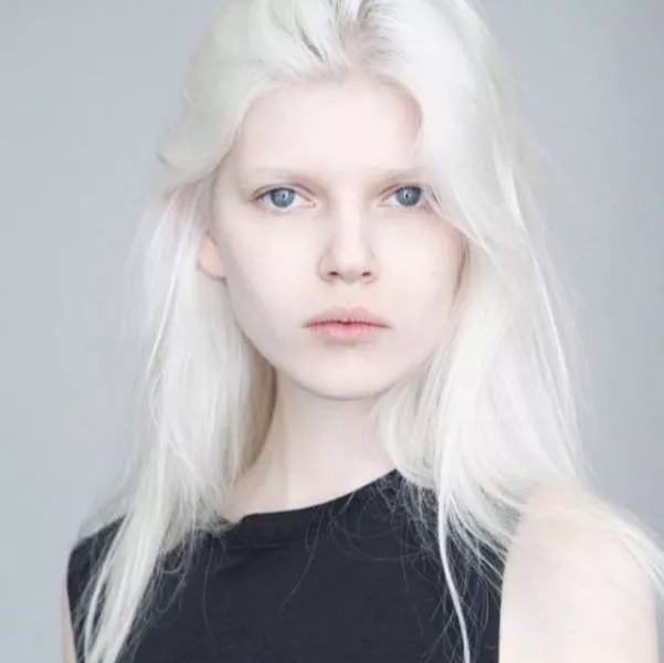 Albinism in pictures