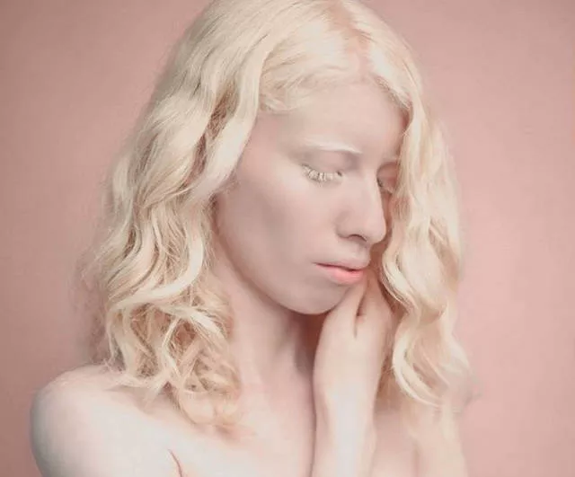 Albinism in pictures - #14 