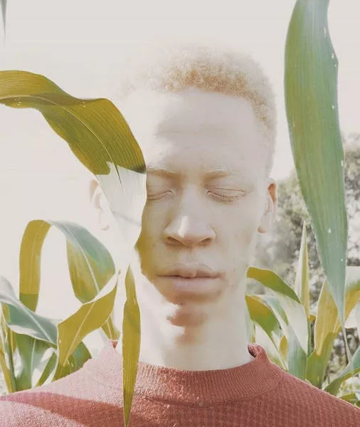 Albinism in pictures - #16 
