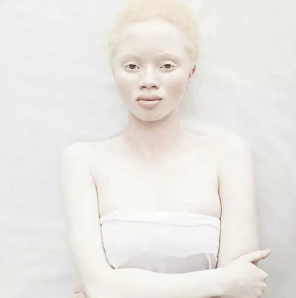 Albinism in pictures - #17 