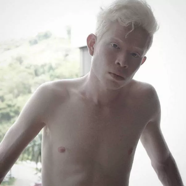 Albinism in pictures - #2 