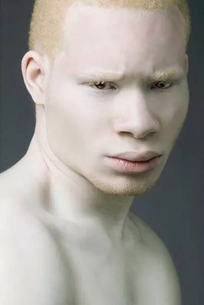 Albinism in pictures - #5 