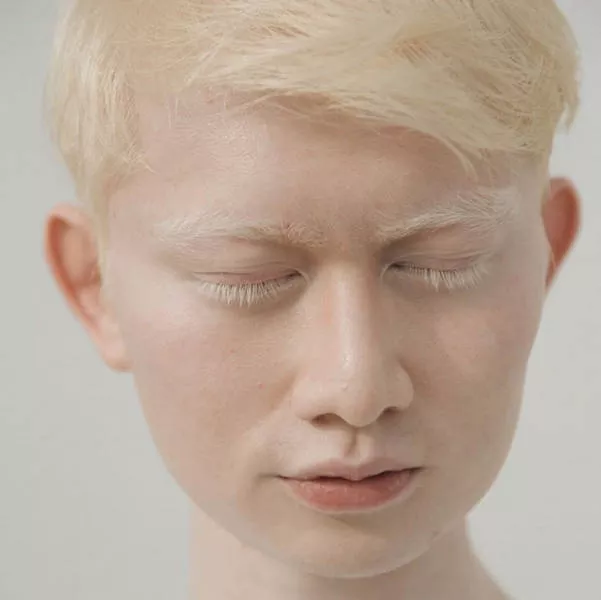 Albinism in pictures - #6 