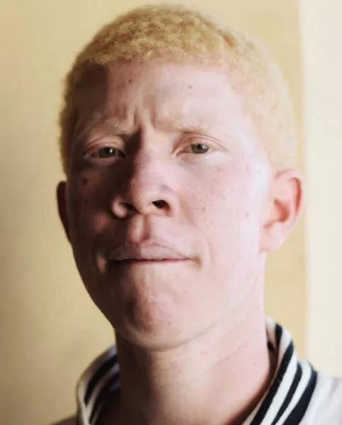 Albinism in pictures - #8 