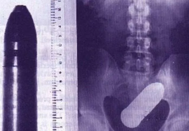 The 3 most terrible x rays in the world