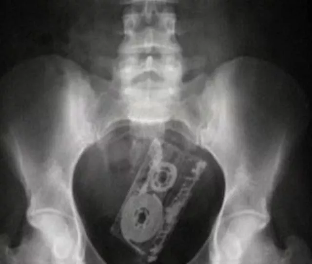 The 3 most terrible x rays in the world - #13 