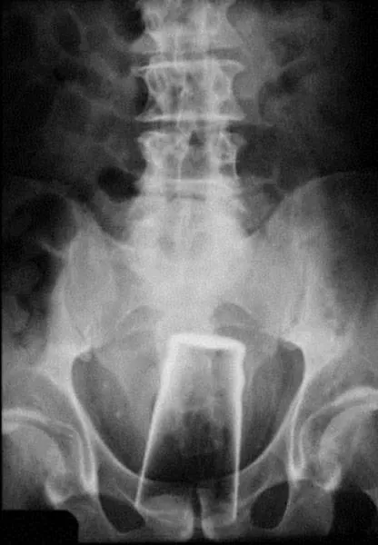 The 3 most terrible x rays in the world - #15 