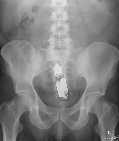 The 3 most terrible x rays in the world - #16 