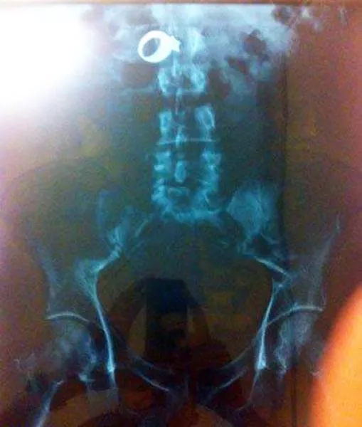 The 3 most terrible x rays in the world - #17 