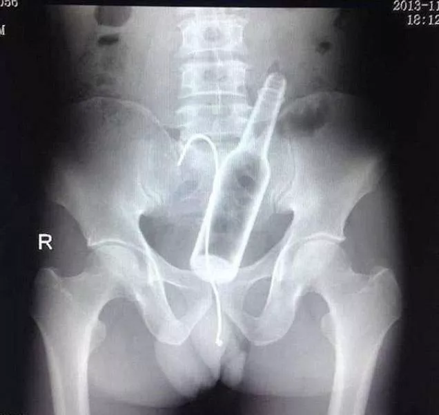 The 3 most terrible x rays in the world