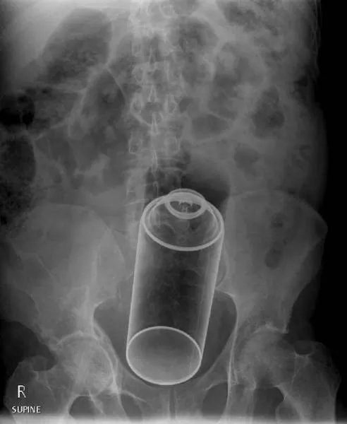 The 3 most terrible x rays in the world - #2 