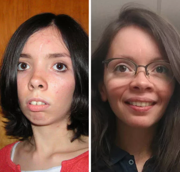 Rcits transformatifs personnes dont lapparence a volu de manire significative - #12 Odyssée dentaire : De 17 à 31 ans, après les appareils et la chirurgie maxillo-faciale