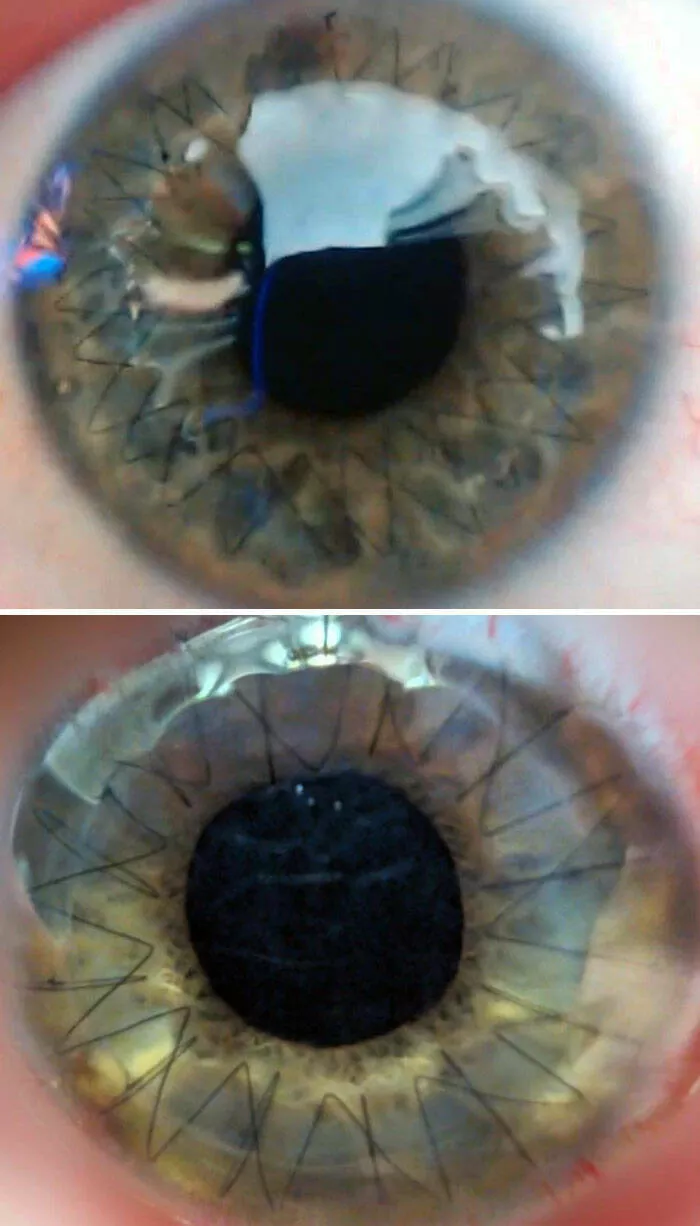 Perspectives dconcertantes photos de comparaison captivantes pour changer votre regard - #20 La différence entre les points de suture de mes yeux après ma première et ma deuxième greffe de cornée