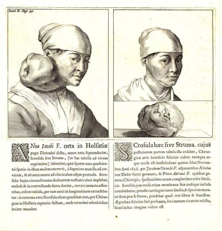 Visual metamorphosis engaging before and after snapshots that mesmerize - #8 A historical medical journal detailing the pre- and post-treatment conditions of a tumor removal in the 17th century: